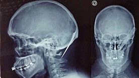 El hombre identificado como Oscar Zelada Jaldin fue operado y permanece fuera de peligro