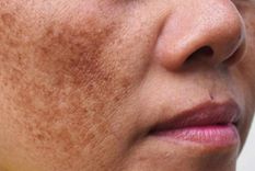 estas son las razones por las que te salen manchas en el rostro