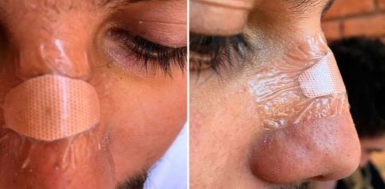 Así quedó el joven sanjuanino agredido en Reñaca. Así quedó el joven sanjuanino agredido en Reñaca.