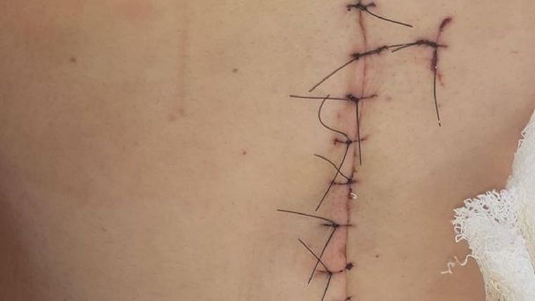 Una de las heridas que le dejó en el cuerpo a su pareja