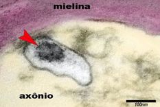 La imagen muestra un axón de una neurona en el cerebro de un niño con síndrome inflamatorio multisistémico pediátrico (SIM-P). La flecha señala al virus SARS-CoV-2 en una vesícula en el citoplasma del axón. Foto: ELIA CALDINI