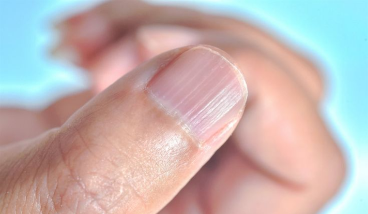 Cuidado, las uñas con rayas te están avisando cómo está tu organismo. Foto: Shutterstock