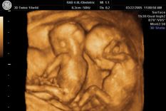 estaba embarazada de gemelos y le entregaron un solo bebe