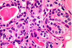 La nueva técnica podría matar una amplia gama de células cancerosas, incluidas las de mama y próstata.