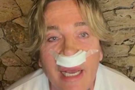 Guido Suller en su última visita a LAM con los rastros de su reciente cirugía estética. / Captura de TV LAM Guido Suller en su última visita a LAM con los rastros de su reciente cirugía estética. / Captura de TV LAM