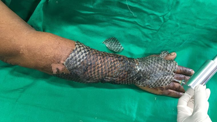 Paciente brasileño tratado con piel de tilapia.