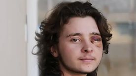 estoy vivo de milagro: perdio un ojo tras ser baleado por un agente de ice en una protesta estoy vivo de milagro: perdio un ojo tras ser baleado por un agente de ice en una protesta