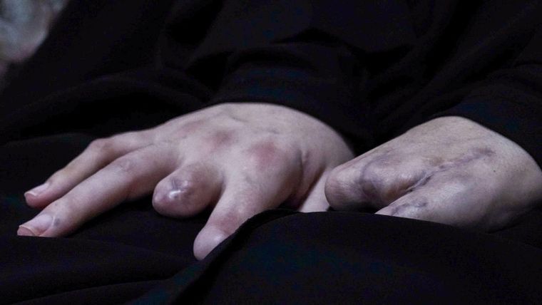 Las manos de Nayfe resultaron gravemente heridas en el ataque del buscapersonas.