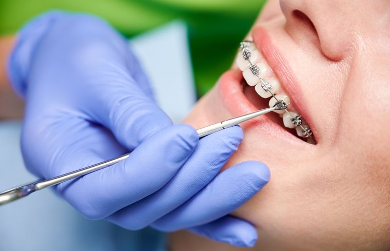 Detectaron brackets falsificados en Chaco y Córdoba: la Anmat ordenó su prohibición en todo el país. Foto: Shutterstock
