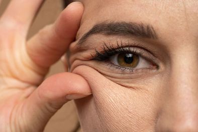 MDZol | Esta fórmula casera te ayudara a eliminar las arrugas Foto: Shutterstock