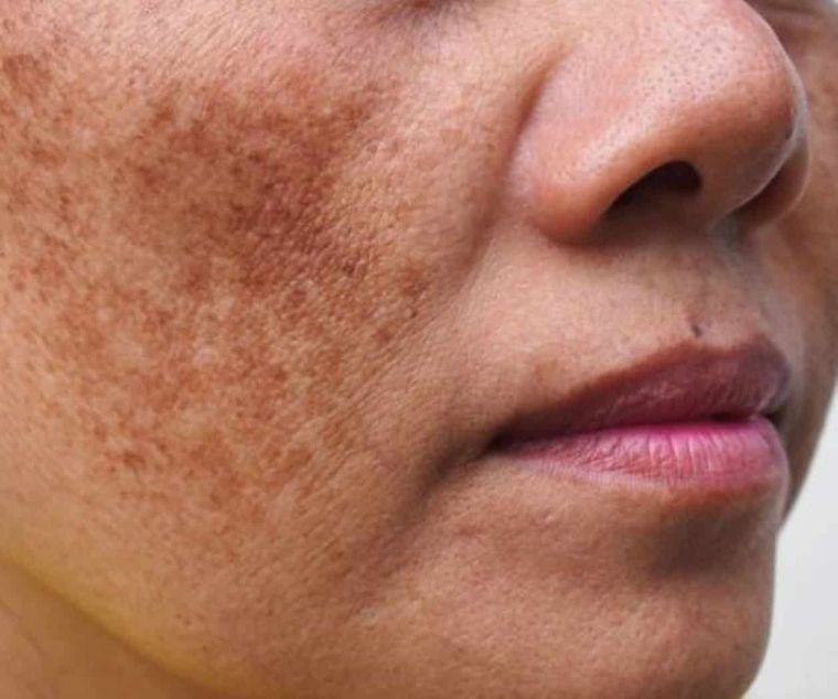 Este remedio casero ayuda a eliminar las manchas en el rostro Foto: Shutterstock