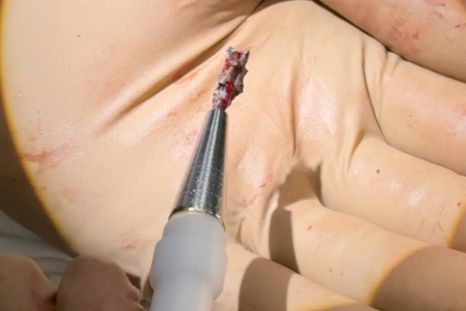 El extractor magnético que extrajo la metralla del corazón de Serhiy.