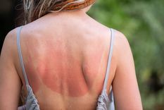 Evitar el sol en horarios críticos durante el verano reduce el riesgo de quemaduras. Foto: Shutterstock