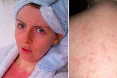 el sufrimiento de una mujer que padece alergia al agua