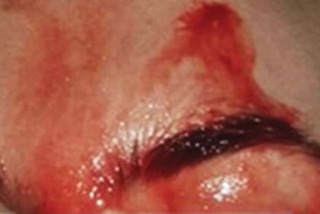 El caso de la joven que suda sangre y no es una santa