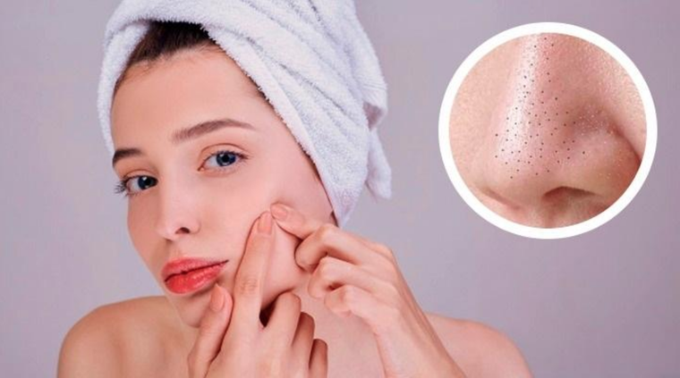 Los puntos negros también se conocen como “comedones abiertos“