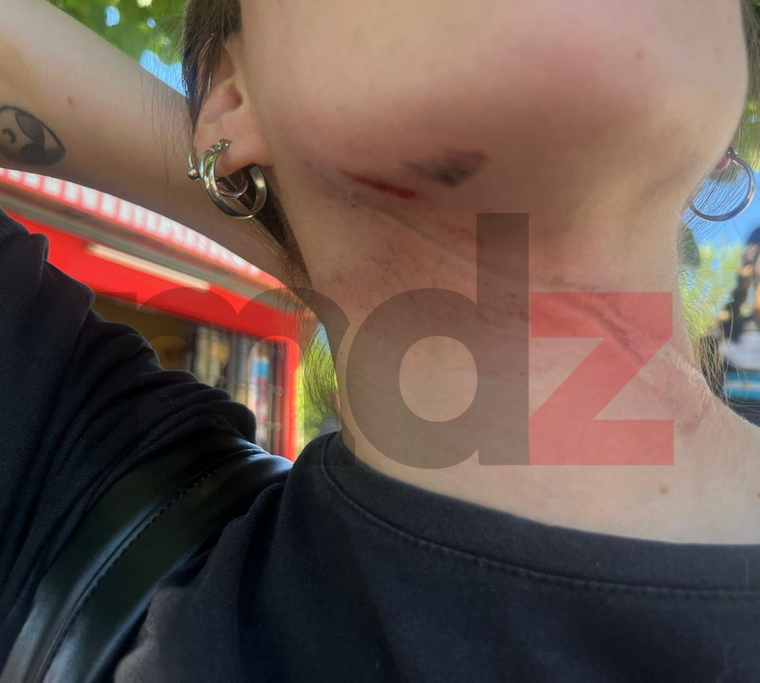 La grave herida que dejó el choque con el cable suelto. La grave herida que dejó el choque con el cable suelto.