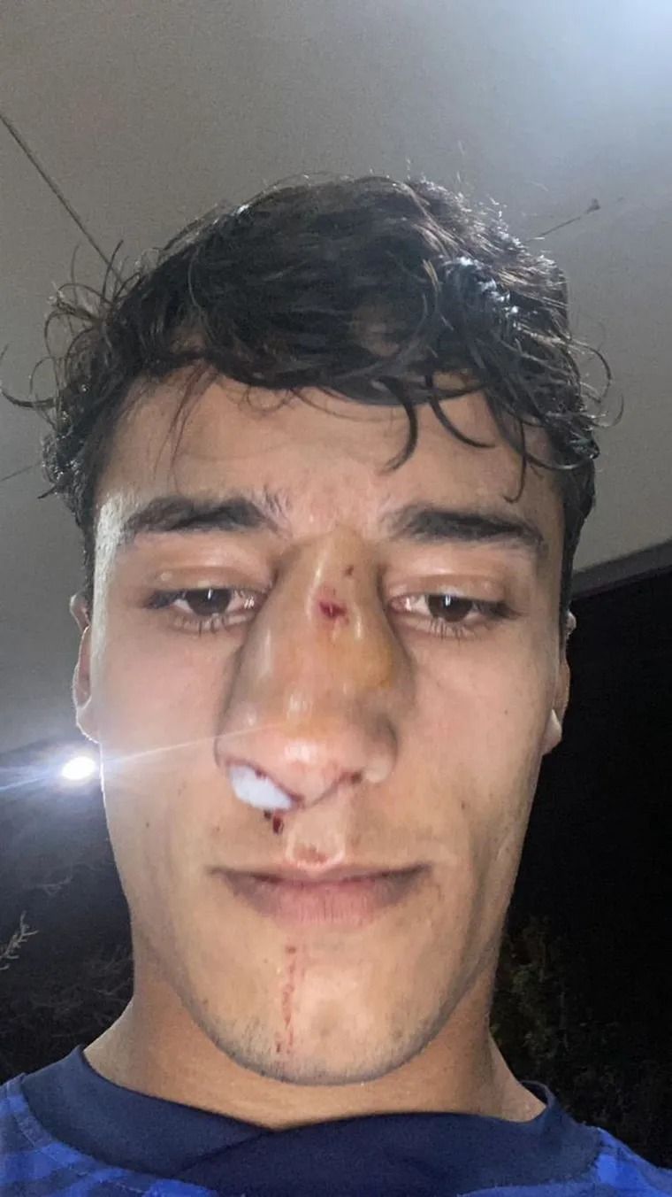 Así quedó Emiliano Britos tras la agresión que sufrió por parte de Matías Chimi Navarro en un partido de la Liga Mendocina.