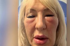 En diciembre de 2023, Andrea apenas podía abrir los ojos y sufría hinchazón alrededor de las mejillas después de recibir rellenos faciales en una clínica de cosmética en Hull, Reino Unido. Foto: BBC