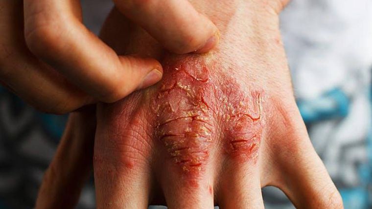 La dermatitis atópica afecta al 10% de la población mundial