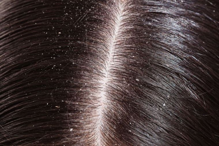 La caspa es un problema capilar molesto y poco estético. Foto: Shutterstock