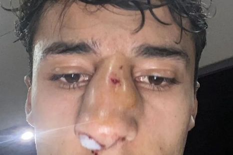 Así quedó Emiliano Britos tras la agresión que sufrió por parte de Matías Chimi Navarro en un partido de la Liga Mendocina. Así quedó Emiliano Britos tras la agresión que sufrió por parte de Matías Chimi Navarro en un partido de la Liga Mendocina.