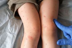 En lo que va de 2025, Canadá contabiliza más de 3.800 casos de sarampión, más que EE.UU.