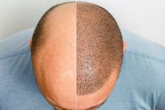 Chau calvicie: consejos de Harvard para recuperar el pelo