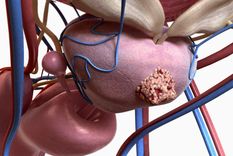 El 70% de los hombres no se realiza los controles hasta que no presentan síntomas de cáncer de próstata.