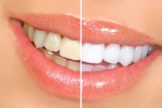 ¡Dile adiós al láser blanqueador! Lo más novedoso para blanqueamiento de los dientes es la pasta dental morada