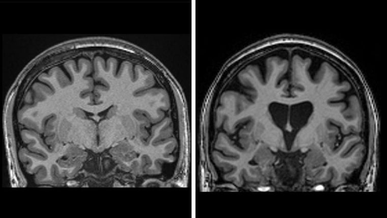 Dos escáneres cerebrales uno al lado del otro. El de la izquierda es sano, el de la derecha muestra la pérdida de materia cerebral a medida que las neuronas mueren en la enfermedad de Huntington.