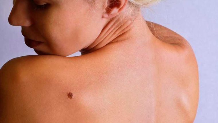 Los lunares deben protegerse del sol como el resto de la piel