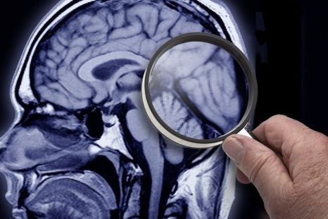 Identifican por primera vez alteraciones estructurales en los llamados “Supercomplejos mitocondriales” que podrían estar asociadas al daño cerebral que provoca la Enfermedad de Alzheimer (EA). Identifican por primera vez alteraciones estructurales en los llamados “Supercomplejos mitocondriales” que podrían estar asociadas al daño cerebral que provoca la Enfermedad de Alzheimer (EA).