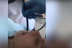 insolito video: extraen una enorme vibora de la garganta de una mujer