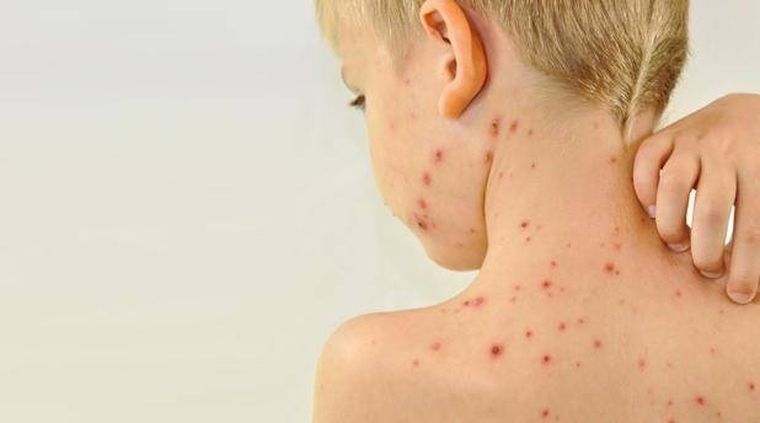 ¿Cómo podés prevenir el sarampión? Foto: Web