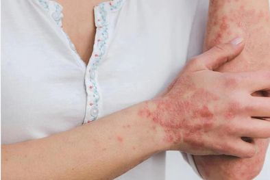 MDZol | Como con cualquier enfermedad infecciosa, la prevención es fundamental. Foto: Archivo
