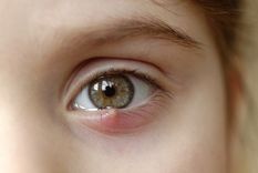 ORZUELO Los orzuelos aparecen cuando hay una infección Foto: SHUTTERSTOCK