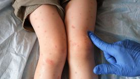 En lo que va de 2025, Canadá contabiliza más de 3.800 casos de sarampión, más que EE.UU. En lo que va de 2025, Canadá contabiliza más de 3.800 casos de sarampión, más que EE.UU.