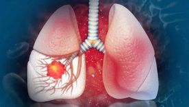 En el marco del Día Mundial del Cáncer de Pulmón, los especialistas coinciden en que la lucha contra esta enfermedad no solo depende de los avances médicos, sino también de la concientización y la detección temprana. En el marco del Día Mundial del Cáncer de Pulmón, los especialistas coinciden en que la lucha contra esta enfermedad no solo depende de los avances médicos, sino también de la concientización y la detección temprana.
