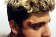 rugbier evito un robo, le dispararon en la cabeza y se salvo de milagr rugbier evito un robo, le dispararon en la cabeza y se salvo de milagr