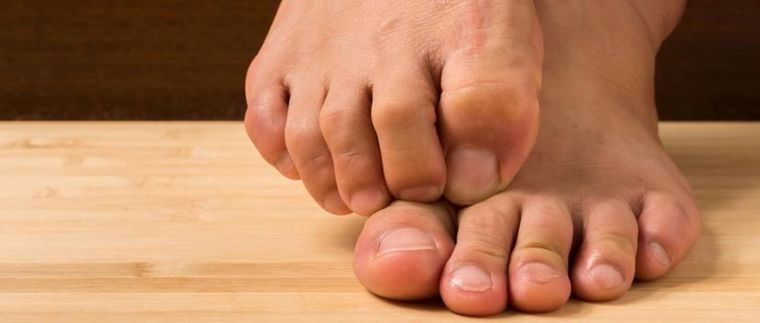 Los hongos en los pies son una infección que provoca picazón, entre otras cosas. Foto: Shutterstock