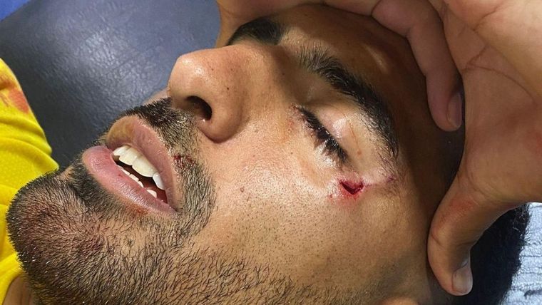 El corte que sufrió Maxi Olivera tras ser agredido por los hinchas de Central. Foto: @OoCLibertadores