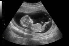 un proyecto de ley busca frenar el aborto cuando hay latido cardiaco