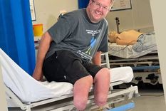 Neil Hopper desarrolló sepsis después de enfermarse en un viaje de campamento. Foto: INSTAGRAM / BIONICSURGEON
