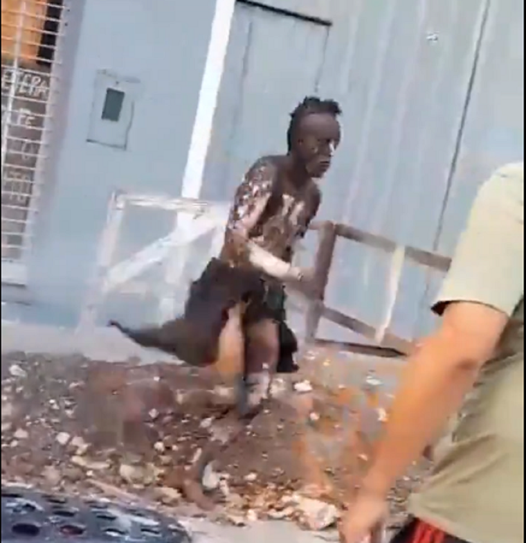 Así salió el hombre luego de quemarse Foto: Captura de video