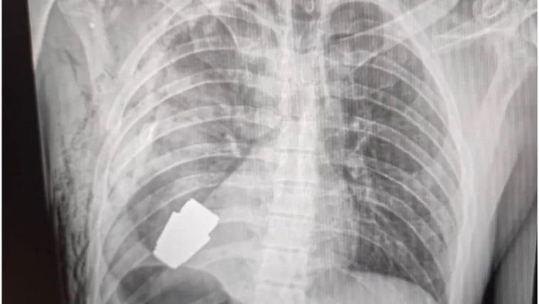 Una radiografía muestra lo cerca que se econtraba la granada del corazón del soldado ucraniano. Foto: HANNA MALIAR FACEBOOK