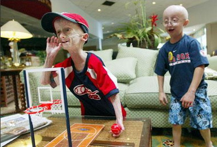 Progeria: envejecimiento prematuro.