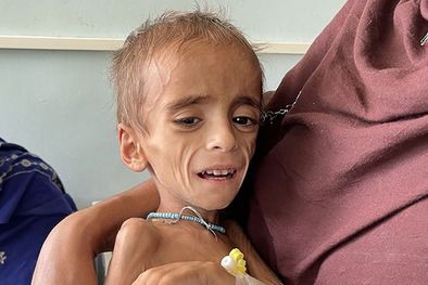 MDZol | Un niño con desnutrición en Kandahar, en Octubre Foto: GETTY IMAGES