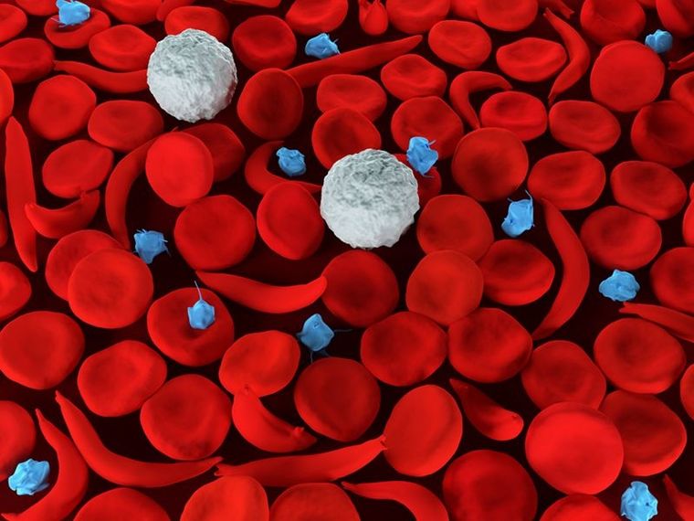 En Argentina uno de cada tres pacientes de mielofibrosis presenta anemia al momento del diagnóstico, y casi el 100% la desarrollará con el avance de la enfermedad. En Argentina uno de cada tres pacientes de mielofibrosis presenta anemia al momento del diagnóstico, y casi el 100% la desarrollará con el avance de la enfermedad.