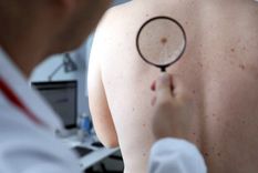 Un estudio español se enfoca en el cáncer de piel. Foto Efe